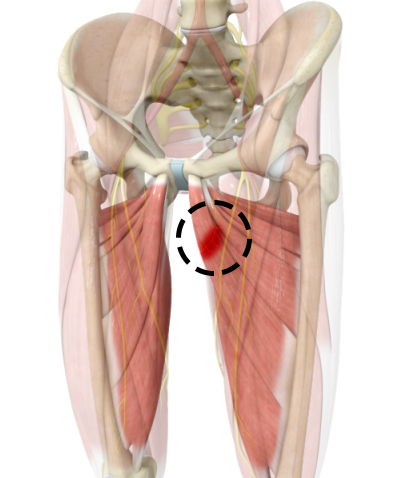 Hip Adductor Injuries - Educational Picture