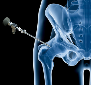 Hip Arthroscopy - Educational Picture