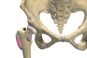 Hip Bursitis Treatment - Educational Picture