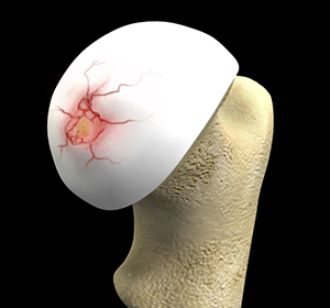 Hip Cartilage Repair - Educational Picture