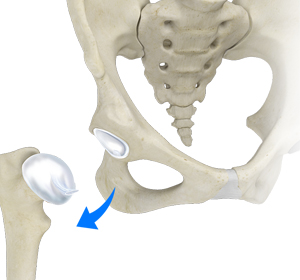 Hip Dislocation - Educational Picture