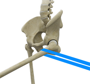 Hip Distraction - Educational Picture