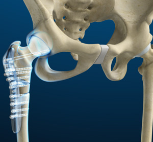 Hip Fracture Surgery - Educational Picture