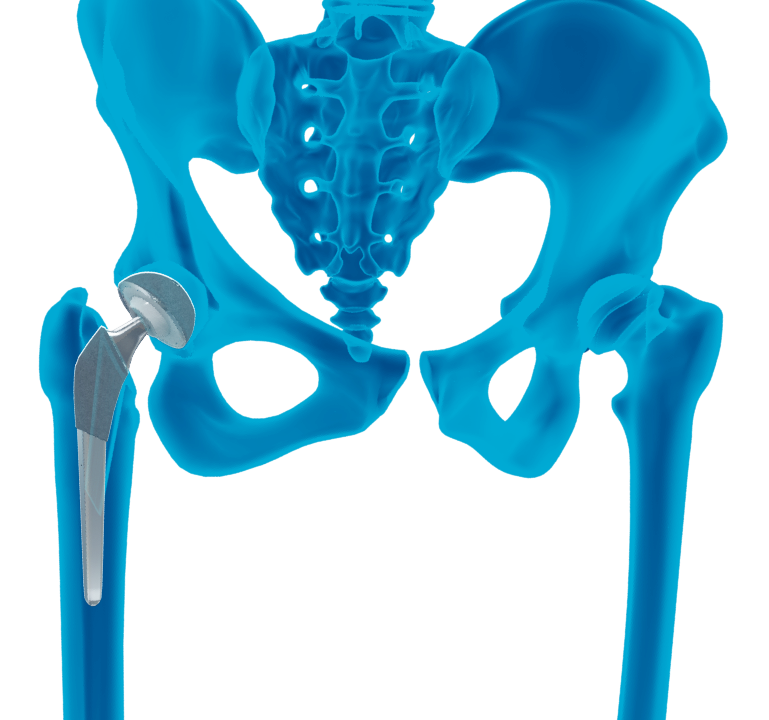Hip Implants - Educational Picture