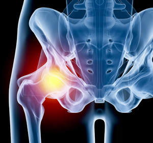Hip Injury - Educational Picture