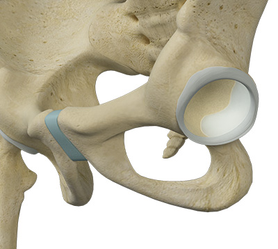 Hip Labral Augmentation - Educational Picture