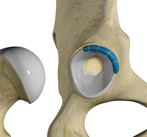 Hip Labral Reconstruction - Educational Picture
