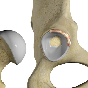 Hip Labral Repair - Educational Picture