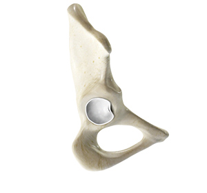 Hip Labral Tear - Educational Picture