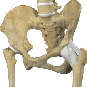 Hip Ligament Injuries - Educational Picture
