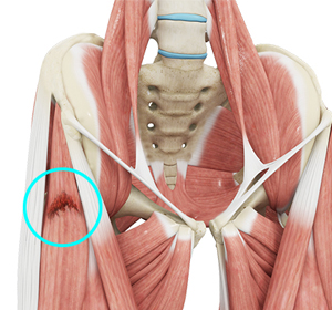 Hip Muscle Strain Treatment - Educational Picture