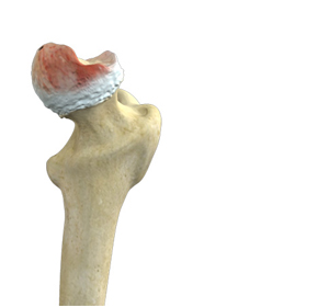 Hip Osteonecrosis Treatment - Educational Picture