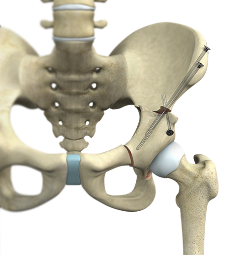 Hip Preservation Surgery - Educational Picture