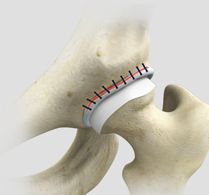 Hip Reconstruction - Educational Picture
