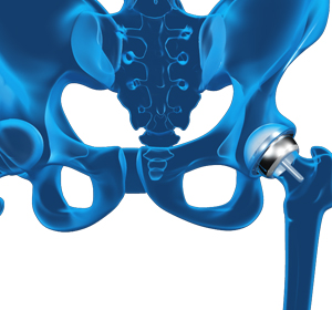 Hip Resurfacing - Educational Picture