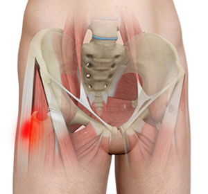 Hip Tendonitis Treatment - Educational Picture