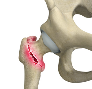 Intertrochanteric Fractures - Educational Picture