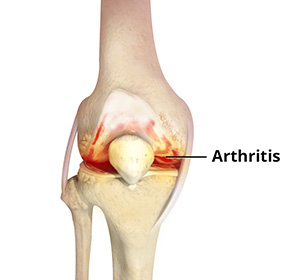Knee Arthritis - Educational Picture