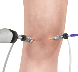 Knee Arthroscopy - Educational Picture