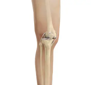 Knee Dislocation - Educational Picture