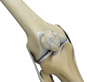Knee Fracture Surgery - Educational Picture