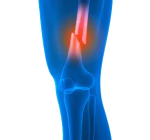 Knee Fracture - Educational Picture
