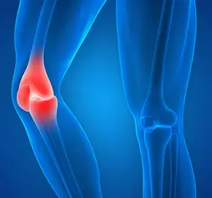 Knee Injury - Educational Picture