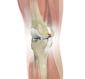 Knee Ligament Injuries - Educational Picture