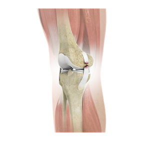 Knee Ligament Injuries - Educational Picture