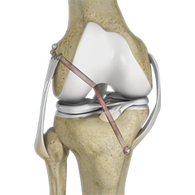 Knee Ligament Reconstruction - Educational Picture