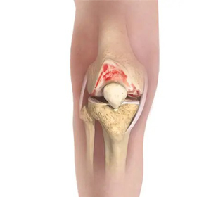 Knee Osteoarthritis Treatment - Educational Picture