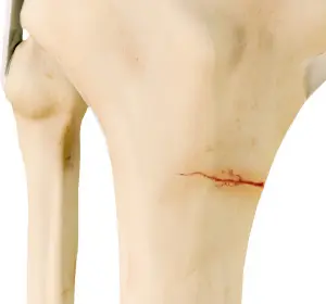 Knee Stress Fractures - Educational Picture