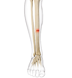 Knee Stress Fractures - Educational Picture