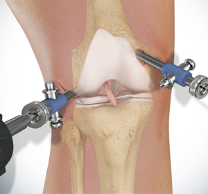 Knee Surgery - Educational Picture