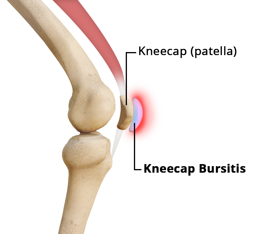 Kneecap Bursitis - Educational Picture