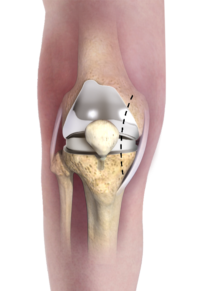 Lateral Approach Total Knee Replacement - Educational Picture