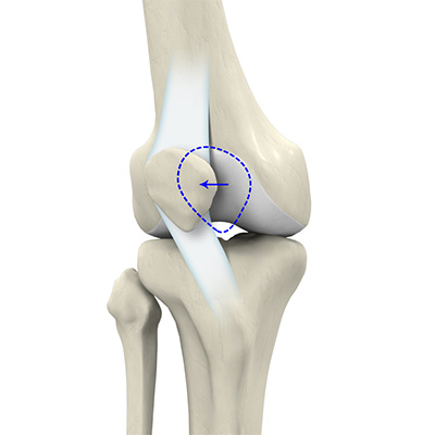 Lateral Patellar Instability - Educational Picture