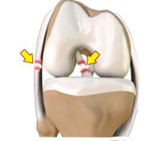 Multiligament Instability - Educational Picture