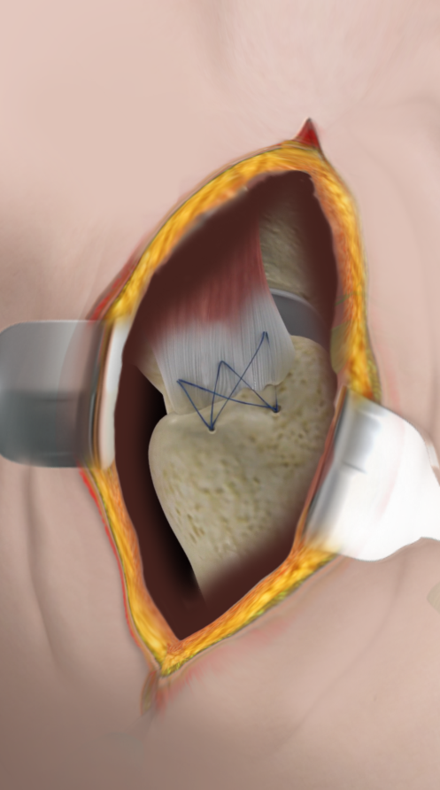 Open Gluteus Medius Repair - Educational Picture