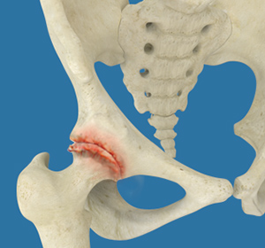 Osteoarthritis of the Hip Treatment - Educational Picture