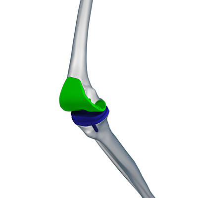 Outpatient Robotic Knee Replacement - Educational Picture