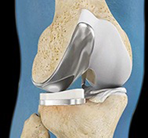 Partial Knee Resurfacing - Educational Picture