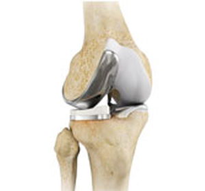 Partial Lateral Knee Replacement - Educational Picture