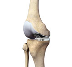 Partial Medial Knee Replacement - Educational Picture