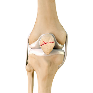 Patella Fracture - Educational Picture
