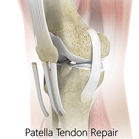 Patellar Tendon Repair - Educational Picture