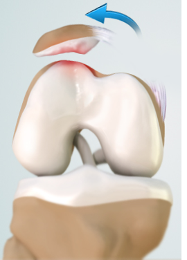 Patellar Dislocation - Educational Picture