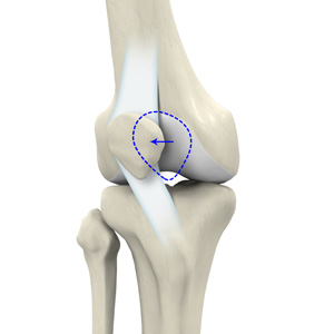Patellar Instability - Educational Picture