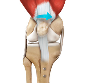 Patella Stabilization - Educational Picture