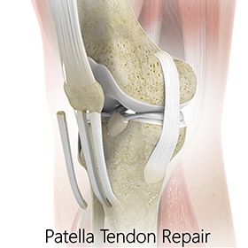Patellar Tendon Tear - Educational Picture